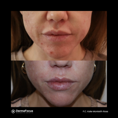 Polynucleotide lip rejuvenation before and after