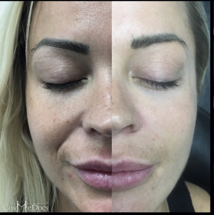 Microneedling before and after skin texture improvement