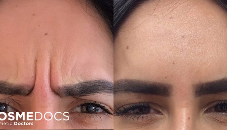 Frown Line Reduction with Botox