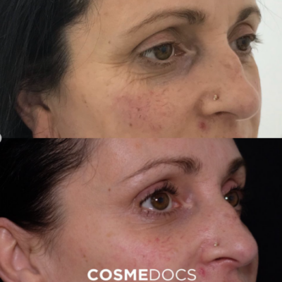 botox for crows feet before and after