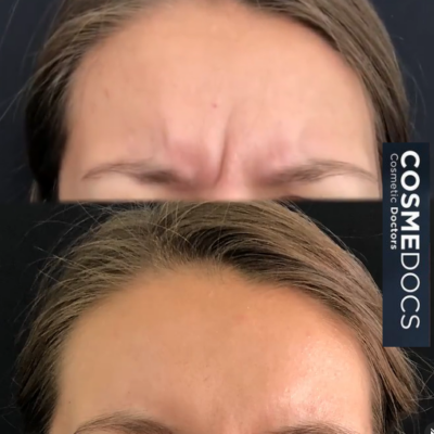 before and after frown lines at Harley Street Botox clinic