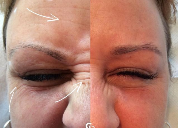 baby botox for wrinkles