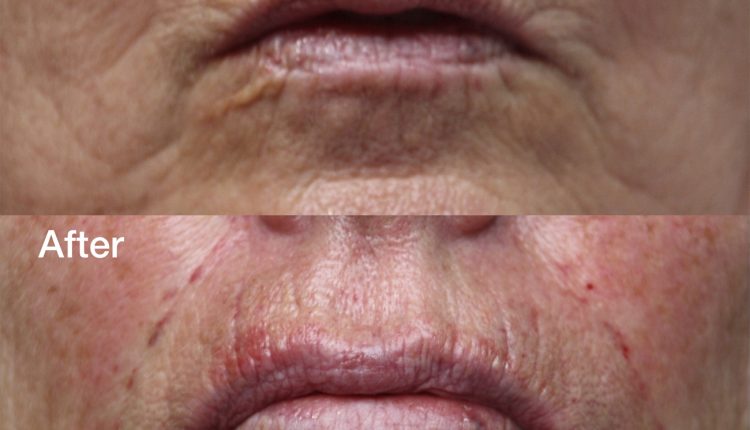 botox-treatment-before-after
