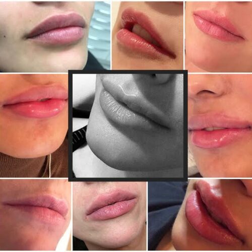 lip enhancement with fillers