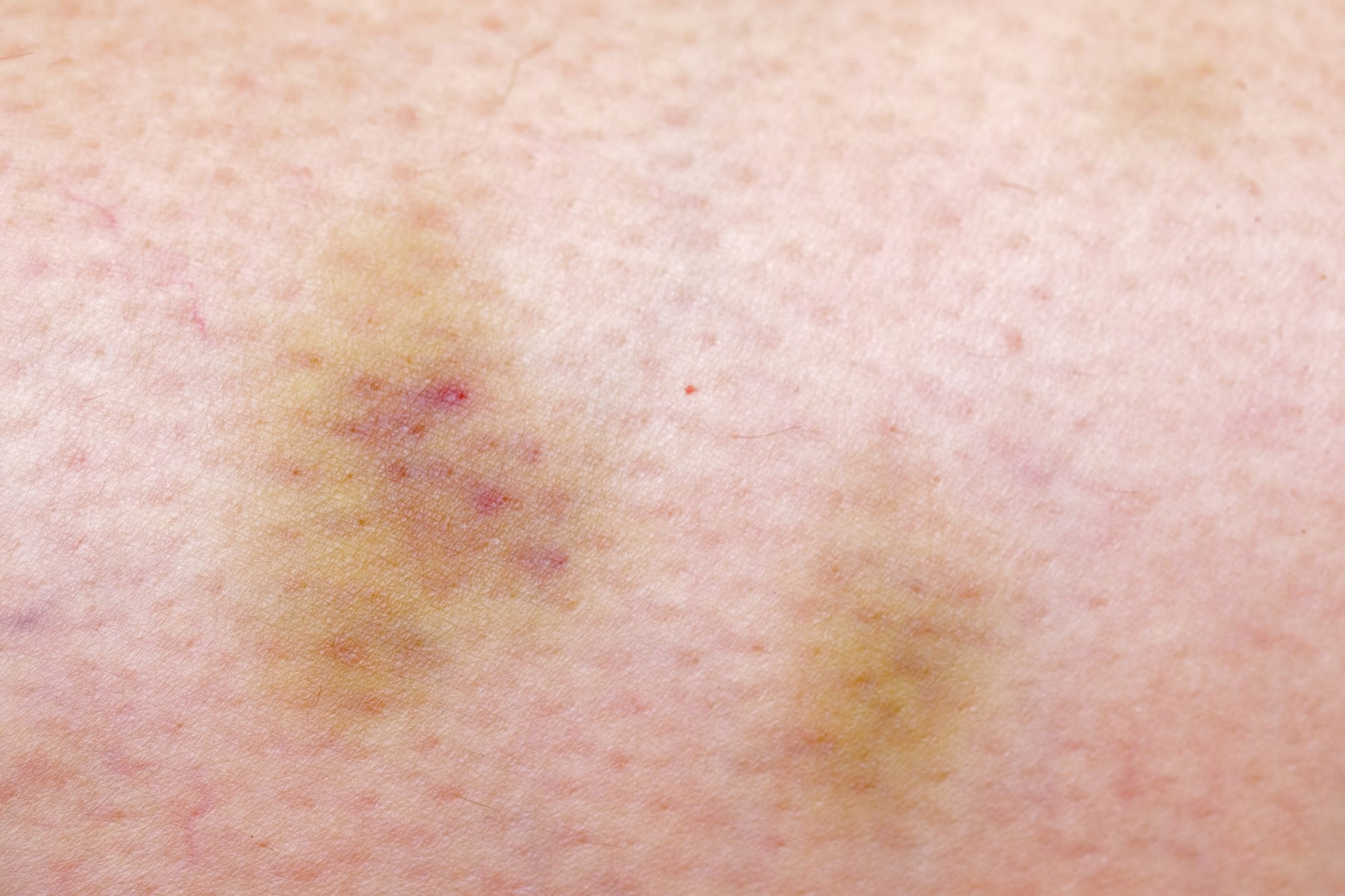 woman skin bruise