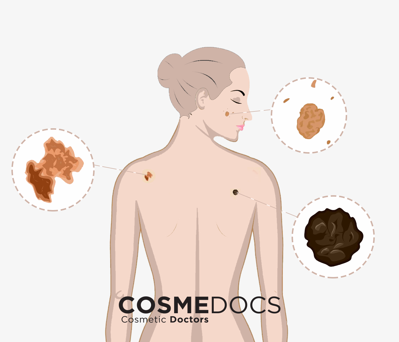 skin-tags-cosmedocs