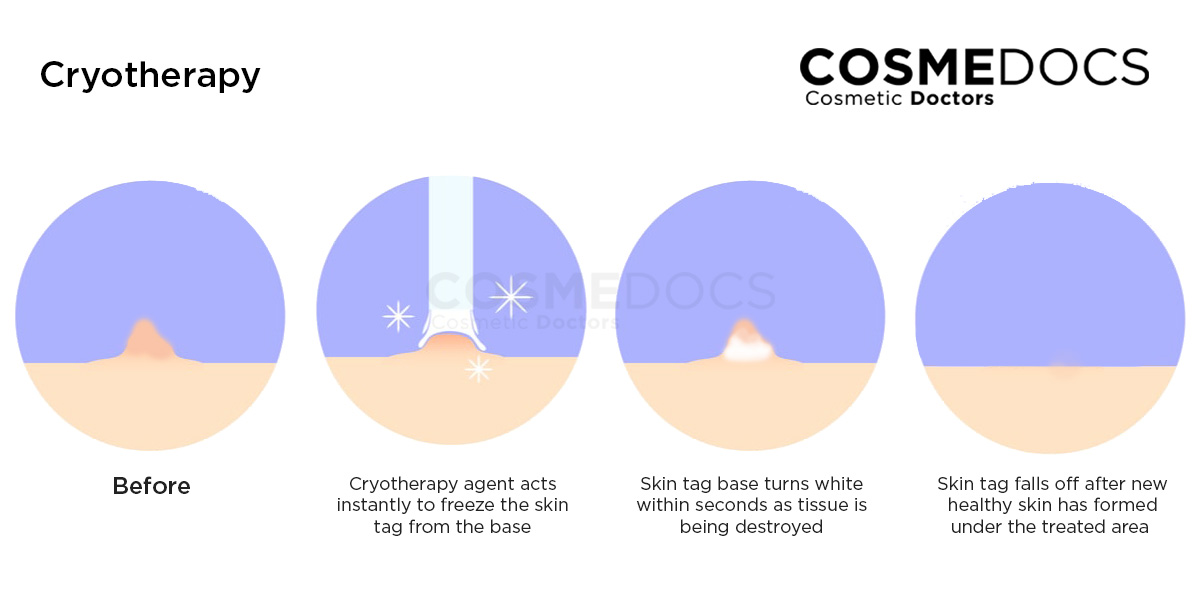 cryotherapy-cosmedocs