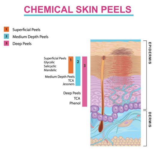 Chemical-Skin-Peel