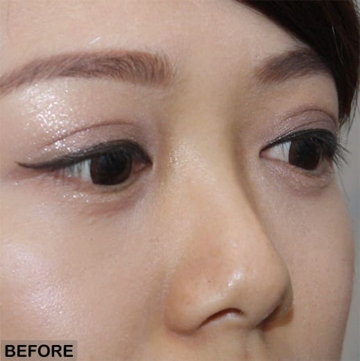 non surgical rhinoplasty asian nose before treatment