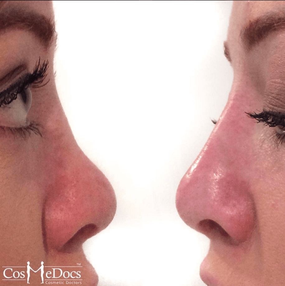 non surgical nose job before and after