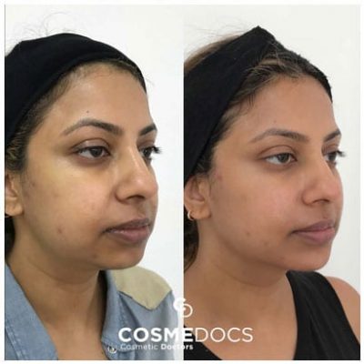 chin-jawline-enhancement-with-dermal-fillers chin jawline enhancement