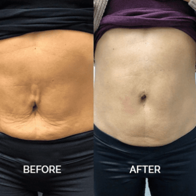 belly fat reduction with laser before and after