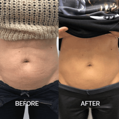 emsculpt-bef-2 belly treatment with emsculpt before and after