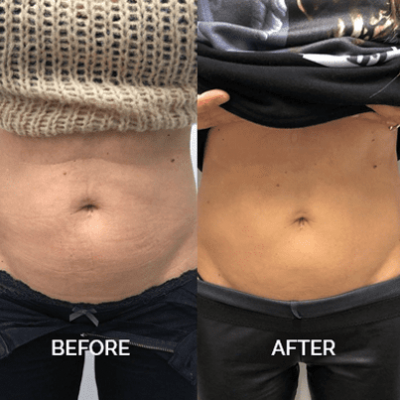 belly treatment with emsculpt before and after