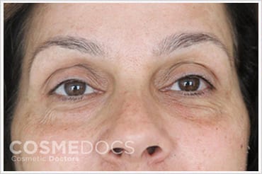 under eye dark circles using face fillers before and after