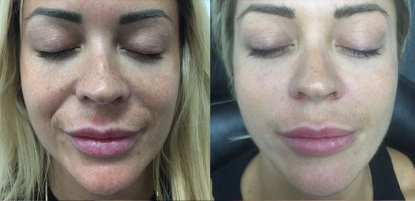 microneedling before after