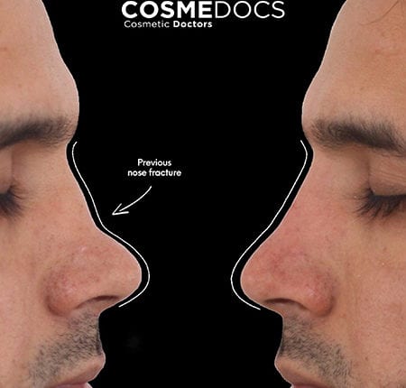 Refining Rhinoplasty with Nose Fillers