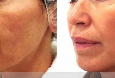 PDO Thread Lift Before And After Images Performed In London