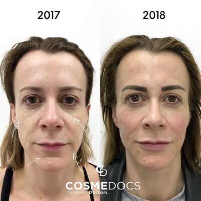 Before and after images of a full-face hyaluronic acid makeover with 1ml lip, cheek, jawline, chin, and tear trough fillers over one year.