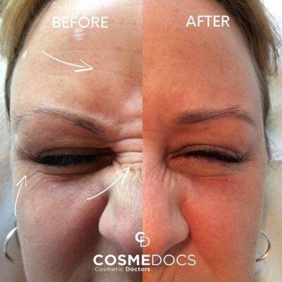 forehead crows feet and frown lines treatment