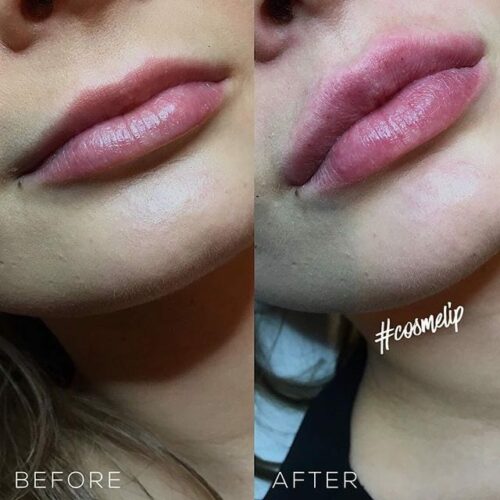 Before and after the use of 1ml lip fillers showcasing enhanced border definition and fullness, achieving a bold and attractive appearance.