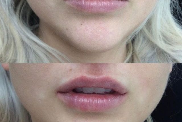 lip-filler-before-after