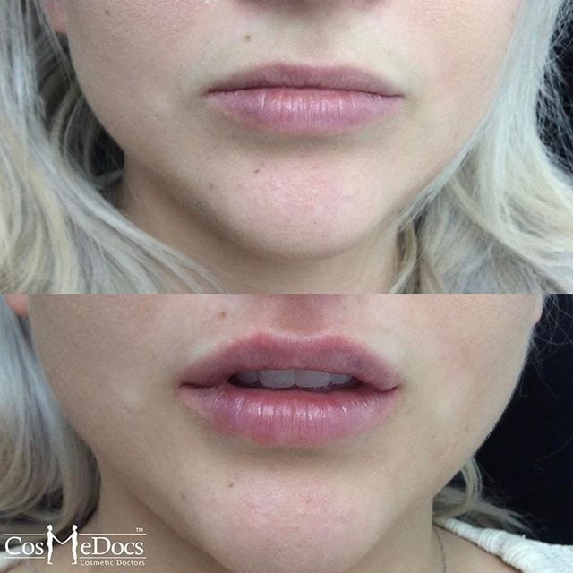 lip-filler-before-after