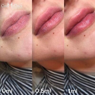 Before and after images of medium lips with 0.5ml and 1.0ml lip filler enhancements, appearing both natural and bold.