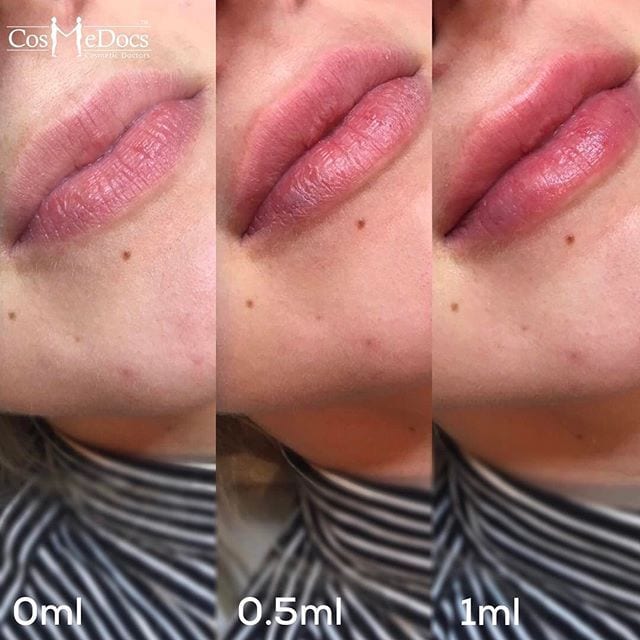 lip-filler-treatment-before-after