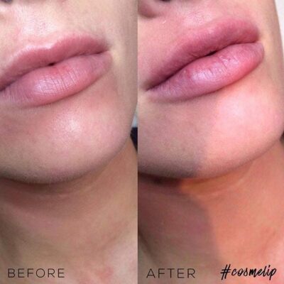 Before and after visuals of 0.5 ML lip hydration, showing fuller lips and smoothed wrinkles."