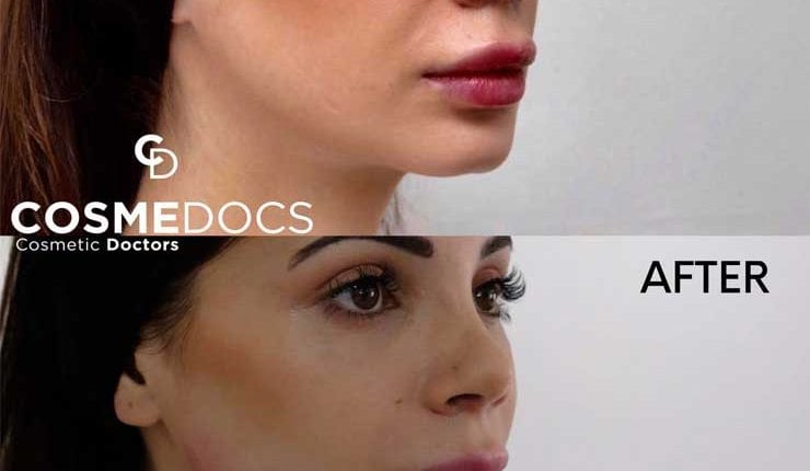 Before and after image of jawline and chin enhancement using fillers.