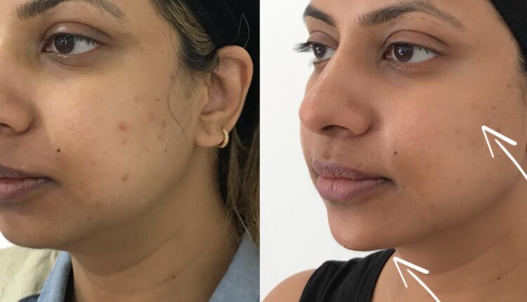 Defined Contours: 1ml Jaw Filler Transformation