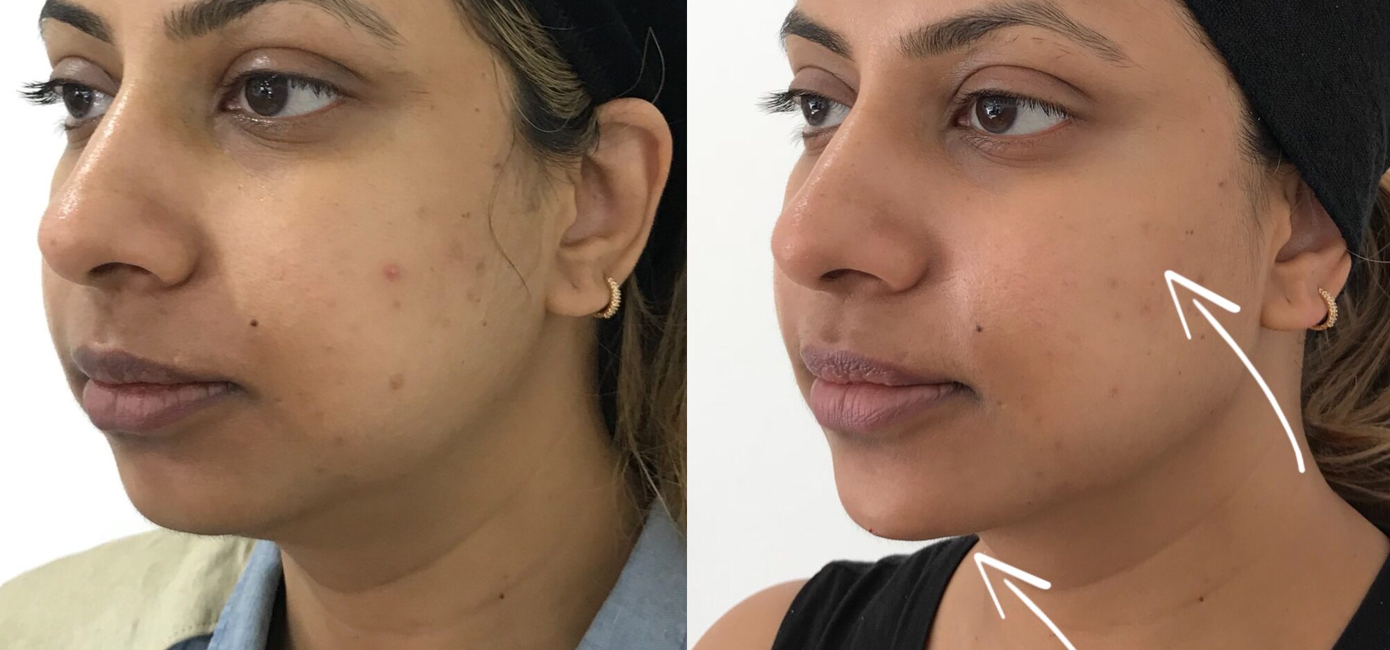 Before and after images showing the impact of 1ml jawline filler on each side