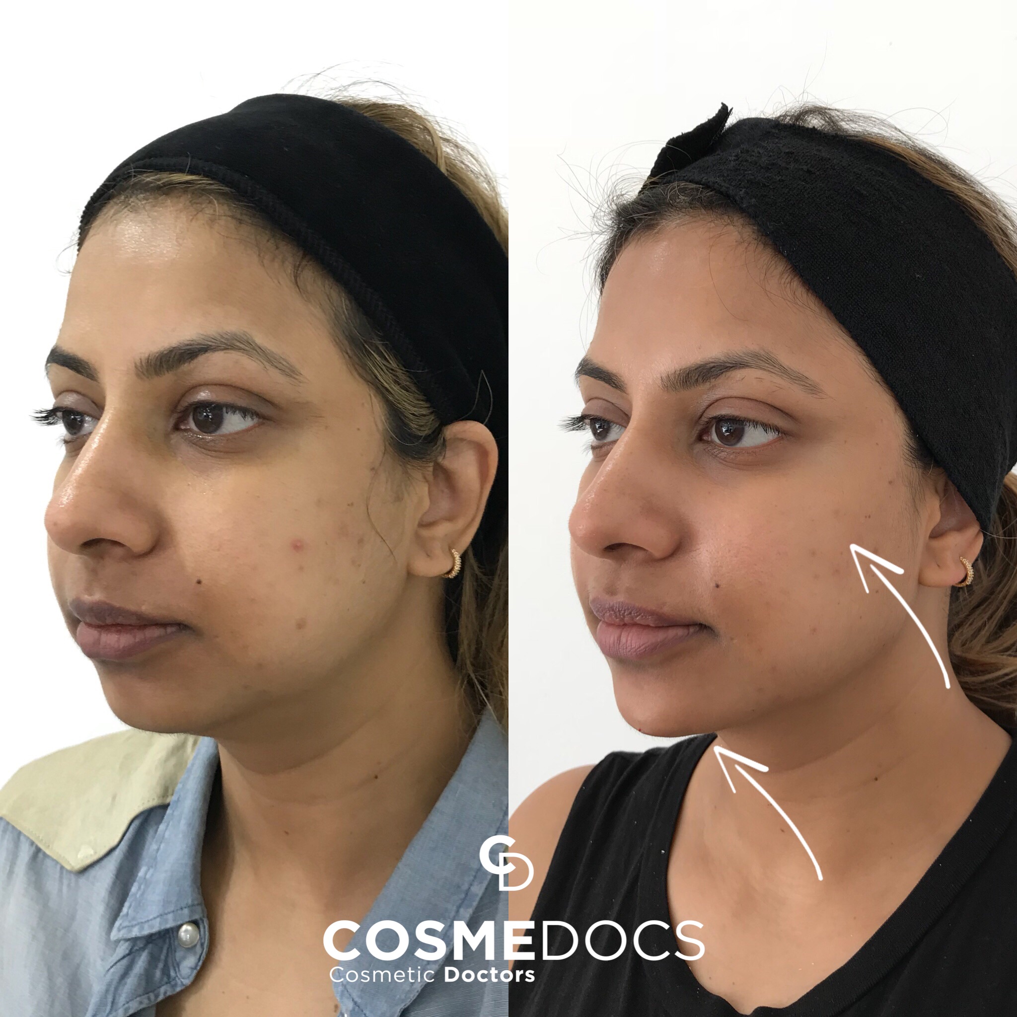 Filler Before And After- Experience Results