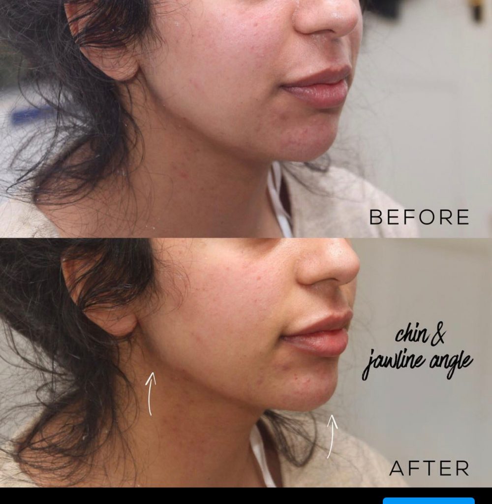 Photo of 1ml jaw filler before and after revealing enhanced jawline and chin