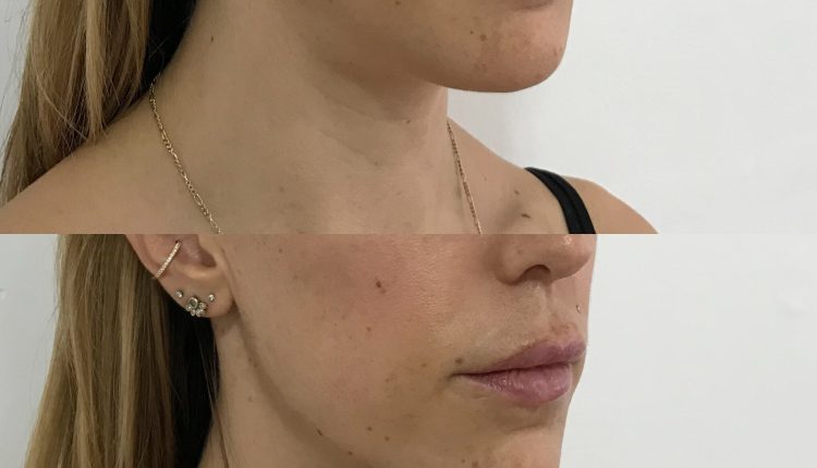 Jaw Filler Before and After Transformation