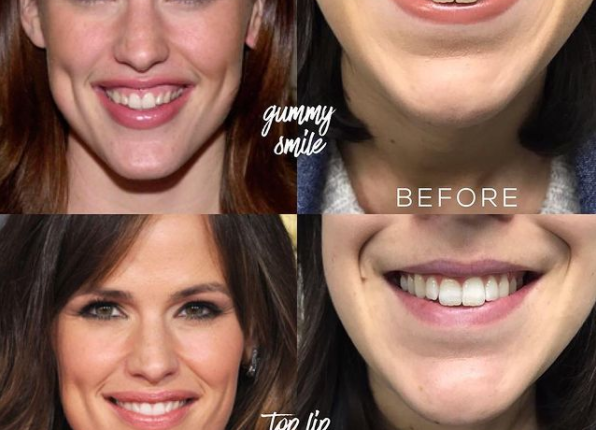 Smile Transformations: Client and Celebrity Gummy Smile Corrections