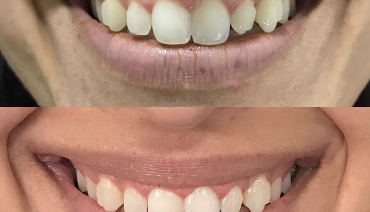 Botox Gummy Smile Correction Before/After