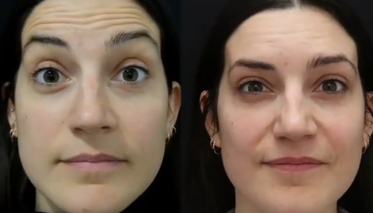 Gentle Forehead Rejuvenation with Botox