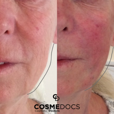 Thread lift before and after in an elderly female at our London clinic