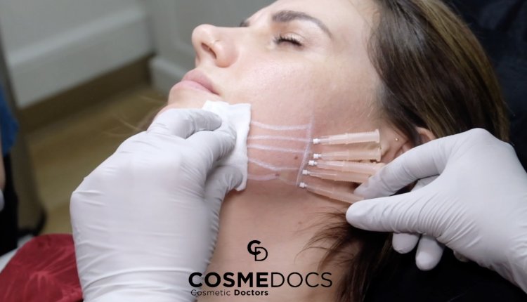 PDO Thread Lift For Jawline Definition