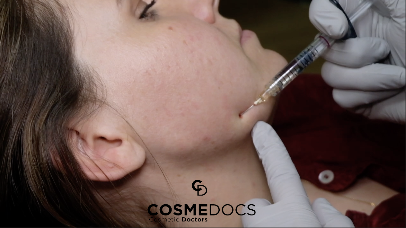 Procedure of applying jawline filler using a cannula technique for enhanced precision.