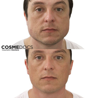 Botox treatment for a large masseter, before and after results