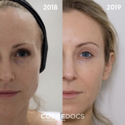 botox brow lift over the years with wrinkle treatment