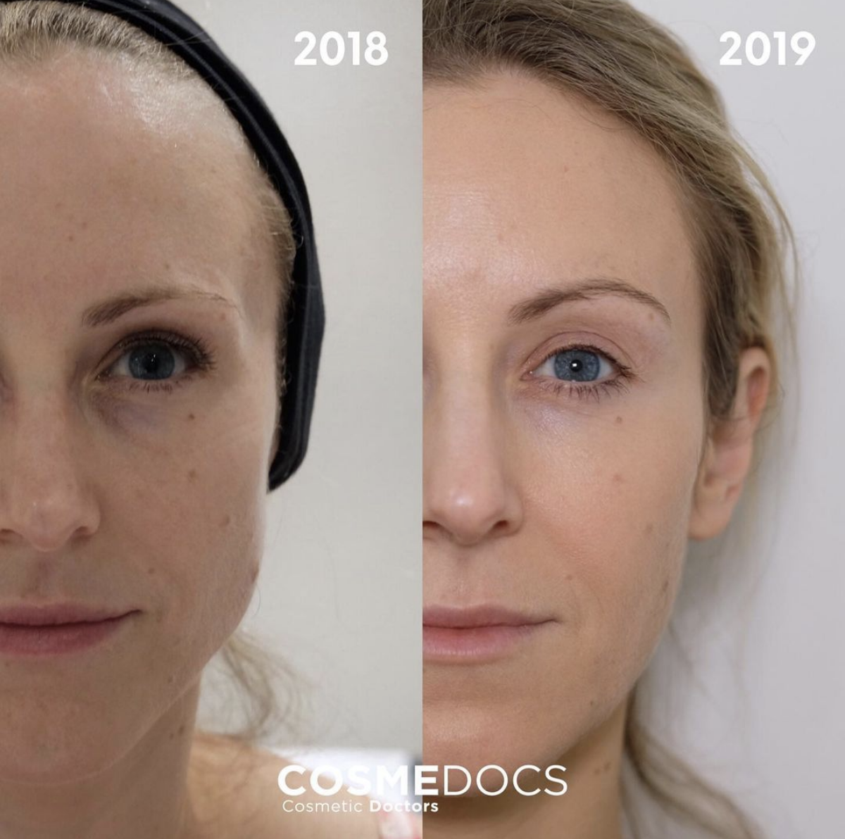 Before and After Photos: Botox Brow and Masseter Reduction