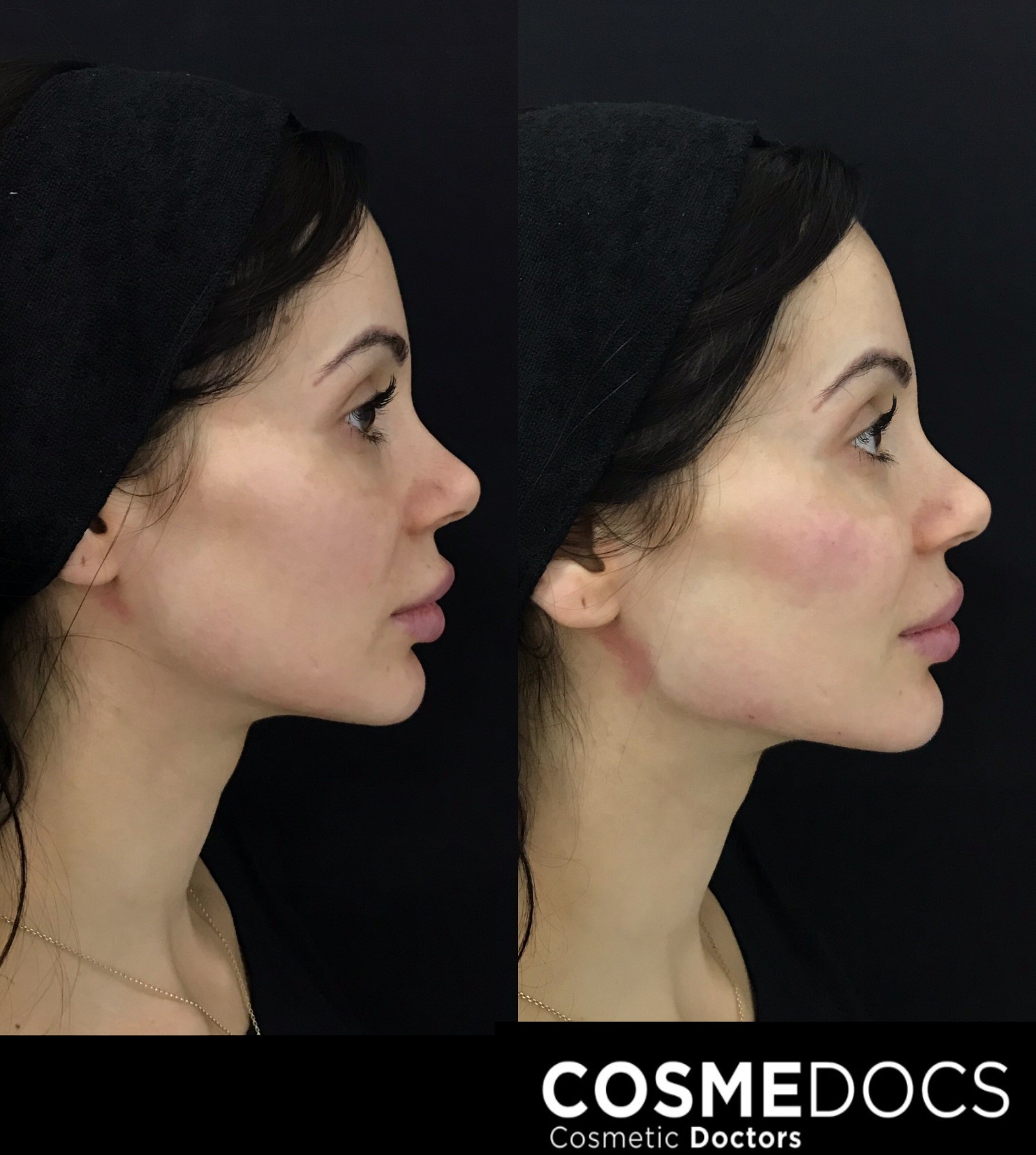 Want A Chiseled Jawline? - NewBeauty