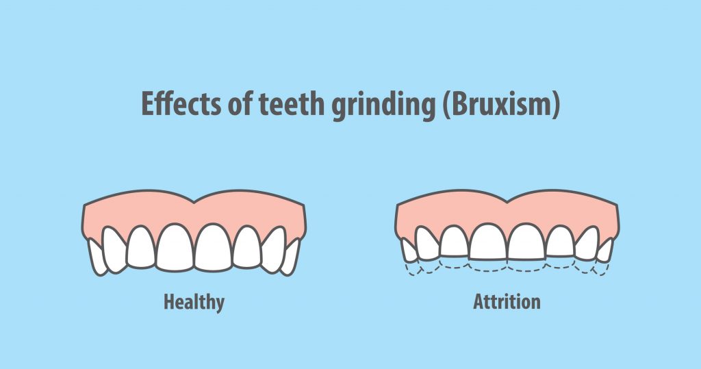 Bruxism effects
