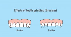 Image of Bruxism (teeth grinding) long term effects on teeth wear and tear