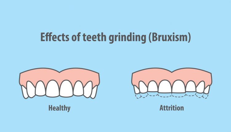 bruxism causing teeth attrition