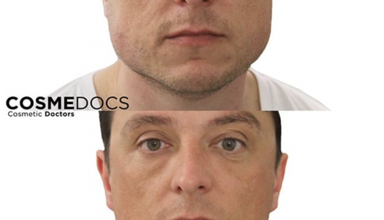 Masseter Botox for Jaw Contouring Before And After